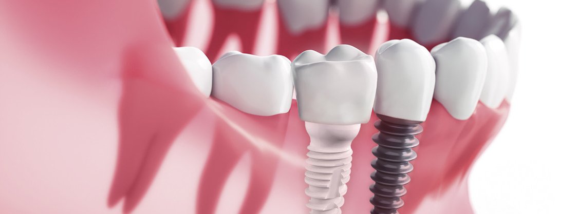 <img src="https://www.cliniquedental.com/wp-content/uploads/2016/05/peridoncia.png" alt="implantes dentales"></noscript>IMPLANTES DENTALES